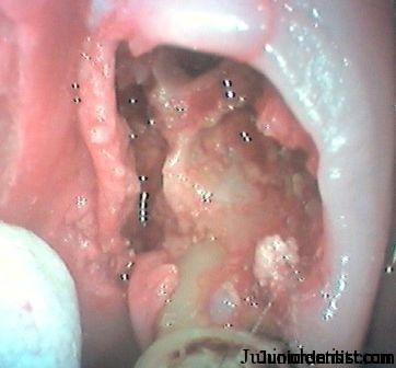 healing socket after tooth extraction