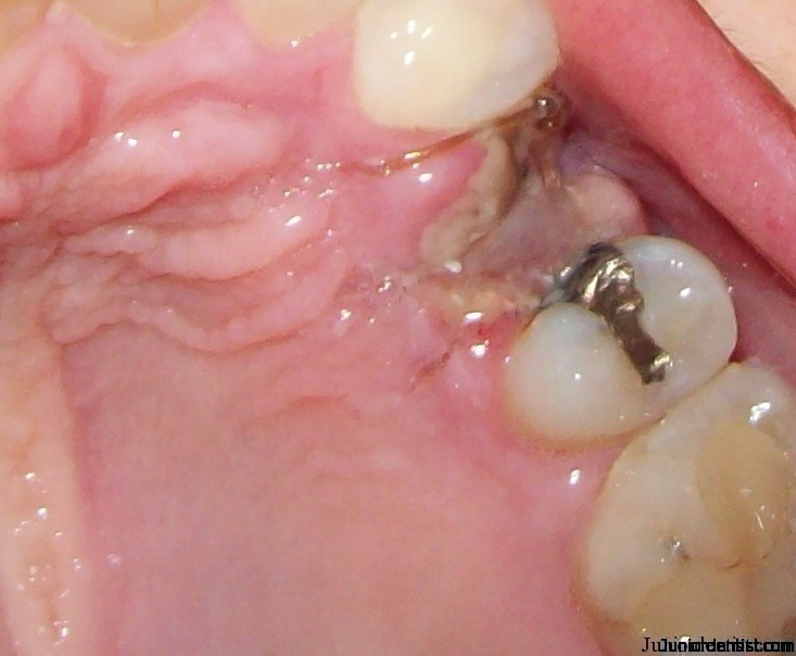 Image of a dry socket in the region of the maxillary left second
