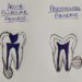 What are Dehiscence and Fenestration | Differences between Dehiscence ...