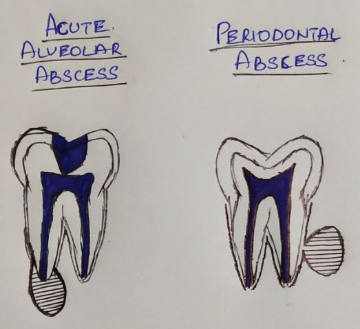 acute apical periodontitis