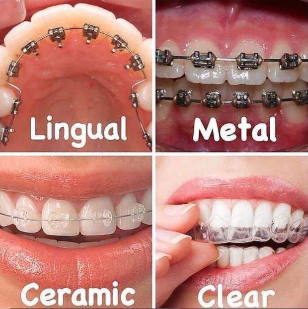 5 Types of Braces for Teeth – Metal, Ceramic, Self Ligating, Lingual and  Aligners