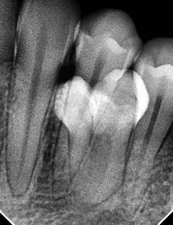 Para Premolar with Gemination RVG Xray