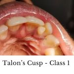 Talons Cusp, Dens Evaginatus