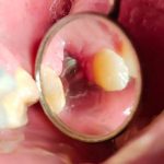 Dental Implant Failure causes