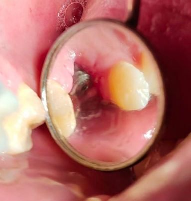 Dental Implant Failure causes