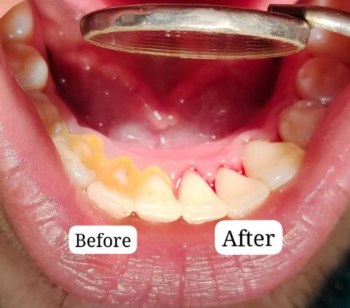 Pain After Scaling or Tooth cleaning