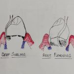 Pain after Scaling or Root Planning