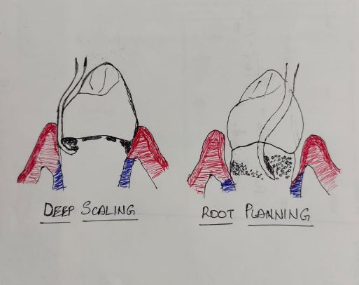 Pain after Scaling or Root Planning