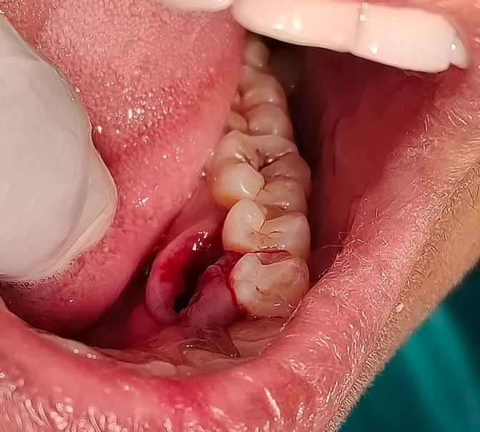 Types of Local Hemostatic Agents in Tooth Extractions